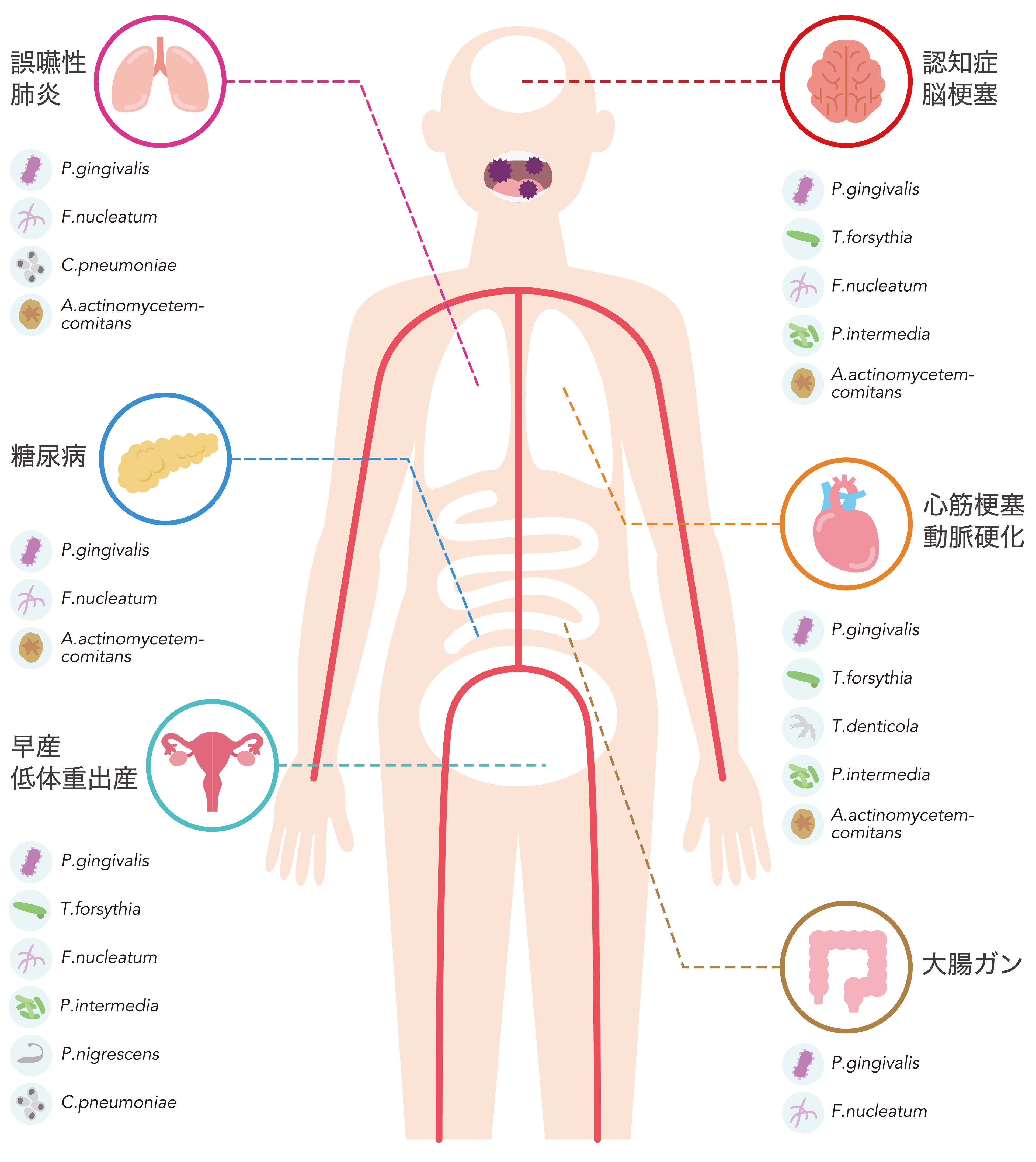 口腔細菌が誤嚥性肺炎、認知症・脳梗塞、心筋梗塞・動脈硬化、大腸ガン、糖尿病、早産・低体重出産など全身の疾患に関わっていることを示す人体図
